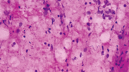 web-p32-33-genetics-nf-1-neurofibromatosis-credit-istock-1465570512.jpg