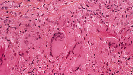 web_p48-51_Feature_Giant Cell Arteritis_Plasma Viscosity As A Diagnostic Marker_Inflamed artery tissue_CREDIT_Science Photo Library-m1750357.jpg