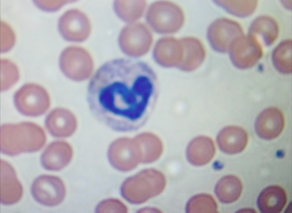 A heart-shaped neutrophil spotted under the microscope