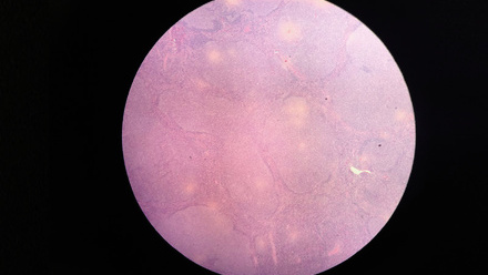 web-p32-33-case-study-follicular-lymphoma-credit-shutterstock-1041683296.jpg