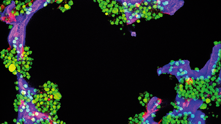 web-p34-37-Myeloma-Multiple-myeloma-cancer-cell_research-Science-Photolibrary--C0303365.png