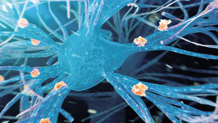 web-p24-27-ibms-research-grants-amyloid-plaques-on-nerve-cells-credit-scienceplf0425219.jpg