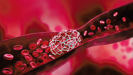 web-p34-35-doac-blood-clot-credit-istock-1329520940.jpg