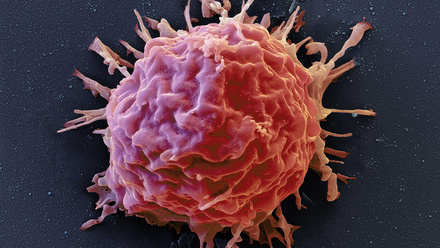 web_p24-25_Acute-lymphoblastic-Leukaemia_Acute-Lymphoblastic-Leukemia-Cell-SEM_CREDIT_Science-Photo-Library_C0354916.jpg